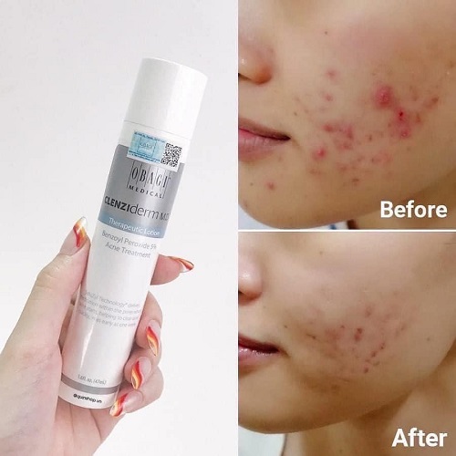 lotion cham mun chua 5% Benzoyl Peroxide Obagi CLENZIderm MD Therapeutic