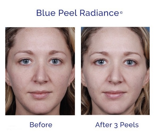 Bo peel thay da sinh hoc Obagi Blue Peel Radiance Kit