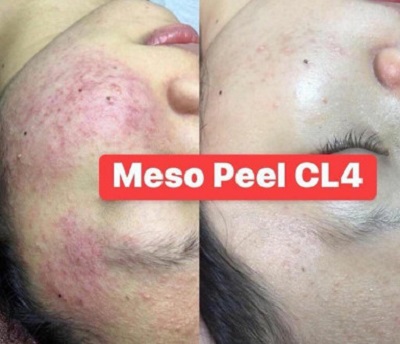 meso peel CL4 peel thao duoc han quoc